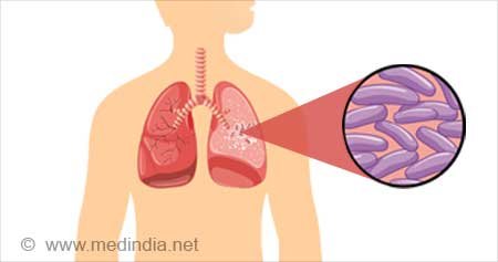 Tuberculosis (TB) Diagnosis & Treatment
